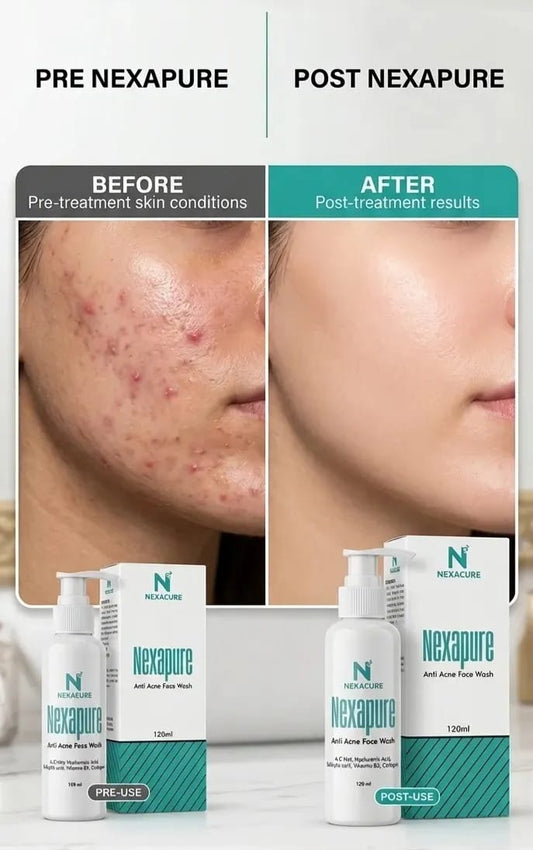 Nexapure Anti Acne Face Wash (120ml)
